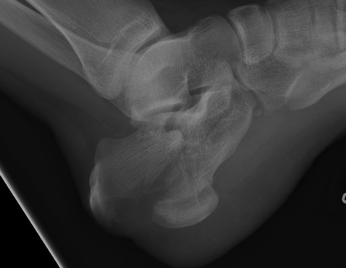 Calcaneal Fracture Tongue Type